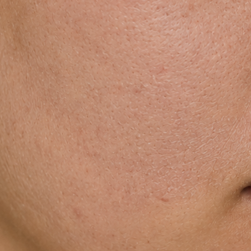 Dull / Dry Skin