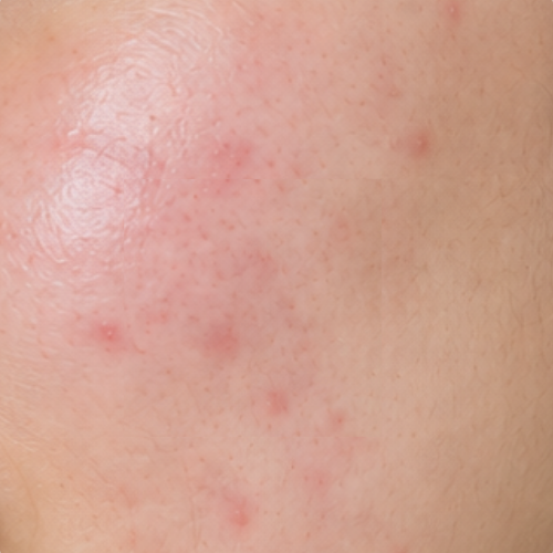 Acne-Prone Skin