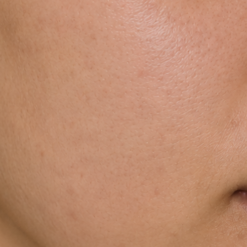 Dull / Dry Skin