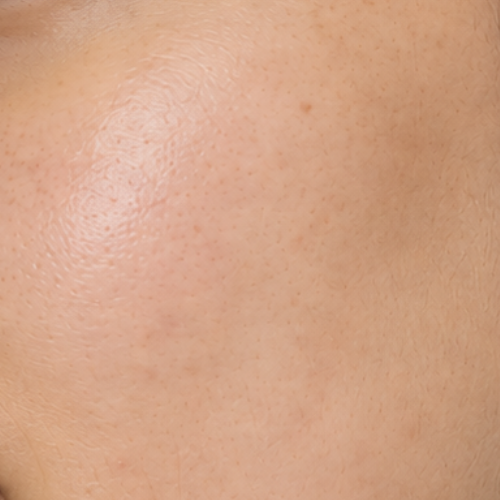 Acne-Prone Skin