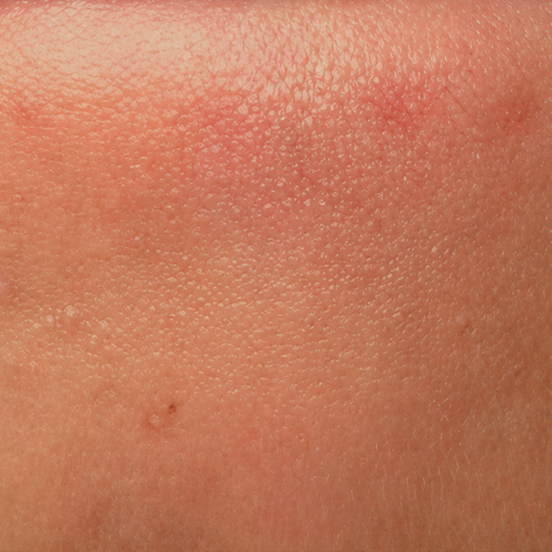 Dull / Dry skin