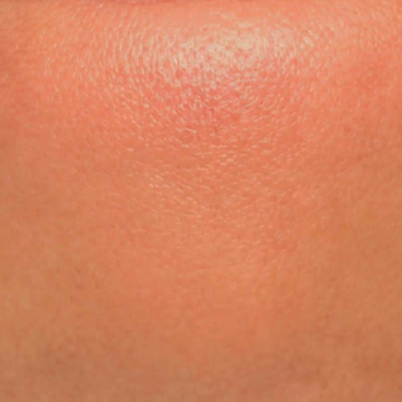 Dull / Dry skin