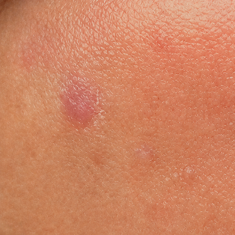 Dull / Dry skin